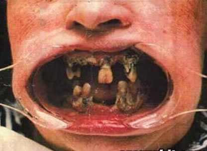 Craze Lines In Teeth
